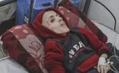 صورة مفحعة لطفل فلسطيني بسبب الجوع