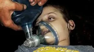 فتاة أصيبت بالسلاح الكيماوي في سوريا